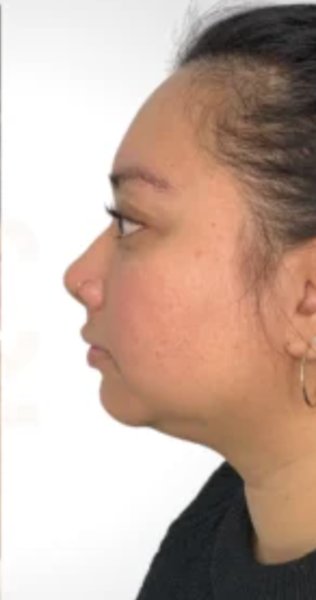 After chin sculpting treatment