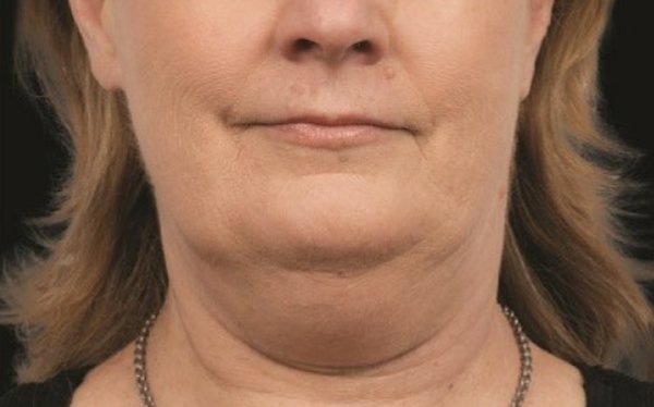 Before chin sculpting treatment