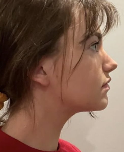 After chin sculpting treatment