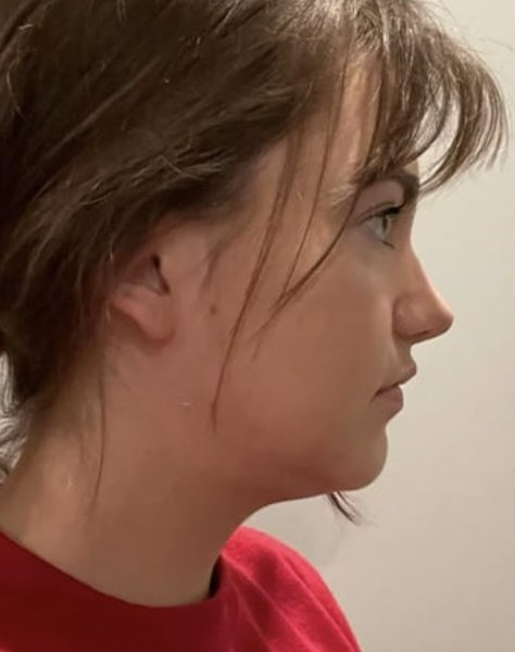 Before chin sculpting treatment